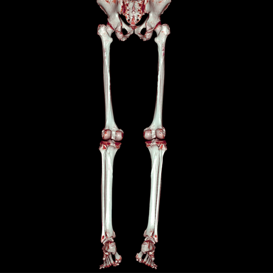 3D CT Left Leg